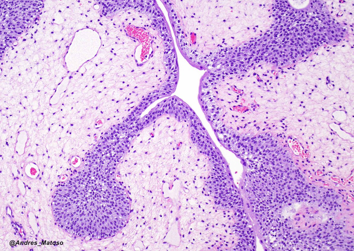 Andres_Matoso's tweet photo. Fibroepithelial polyps of the bladder can be challenging to diagnose due to its rarity. Usually located in bladder neck, the epithelial component can present anastomosing trabecular urothelium or cystitis cystic. The stromal component consist of bland spindle cells. #gupath https://t.co/s5Fh0VrSvT