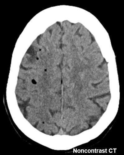 #AJNRcc &gt;&gt; November 20, 2023 &gt;&gt; What is the diagnosis for this 77-year-old woman with atrial fibrillation who presents with altered mental status after undergoing catheter ablation? Submit your answer at ow.ly/ctXf50Qcy4z