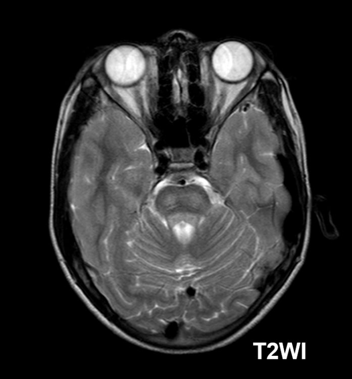 #AJNRcc &gt;&gt; November 27, 2023 &gt;&gt; What is the diagnosis for this 9-year-old boy with dysarthria, tremor, motor tics, and decreased scholastic performance for 1 year? Submit your answer at ow.ly/KikS50Qcyi2