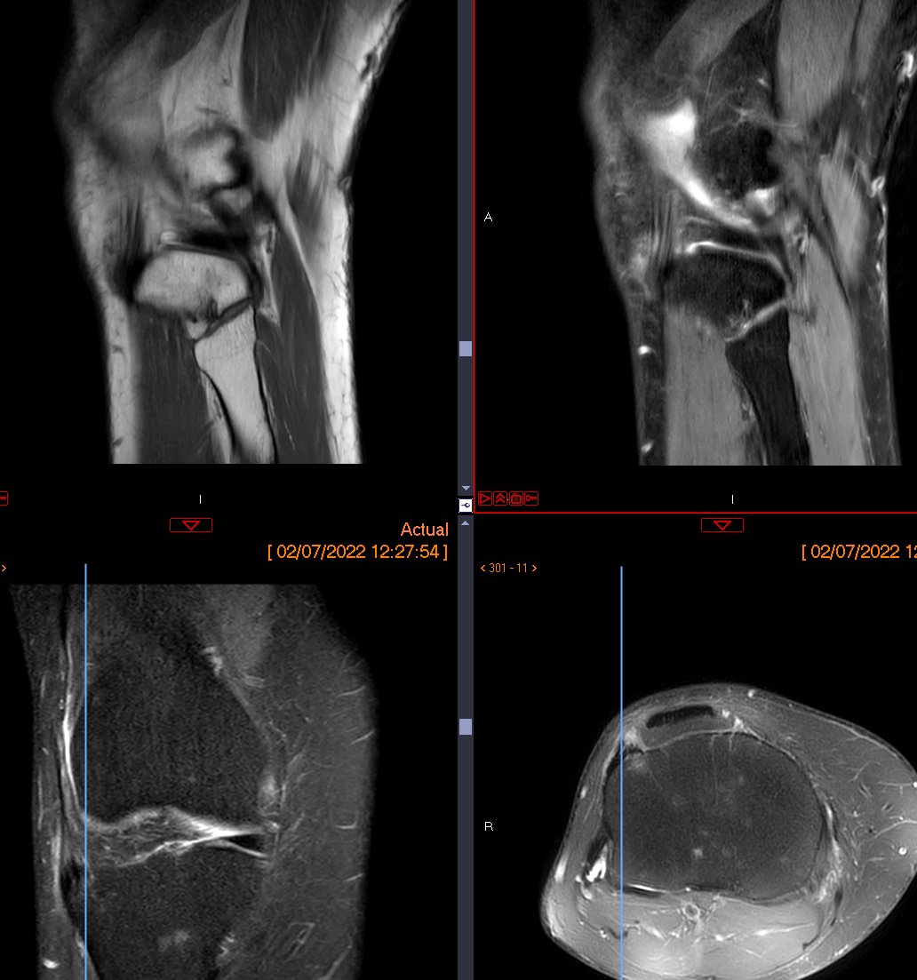 Distal iliotibial band enthesitis - A 55-year-old woman presents with a painful swelling on the anterolateral side, raising clinical suspicion of external meniscopathy. #Orthopedics #Enthesitis