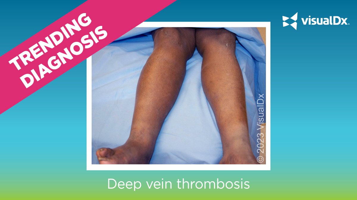 📈 Trending diagnosis alert! 📈 Our top search is deep vein thrombosis - a condition you can't miss! This is when blood clots form in the deep veins. Signs include localized swelling, erythema or tenderness. Learn more at bit.ly/46AtAkM