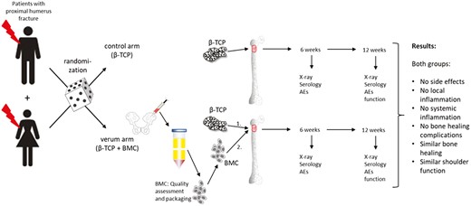 This study assessed whether autologous bone marrow-derived mononuclear cells plus β-TCP added to the standard operative treatment for proximal humerus fractures (open reduction internal fixation) could reduce the incidence of secondary dislocations. doi.org/10.1093/stcltm…