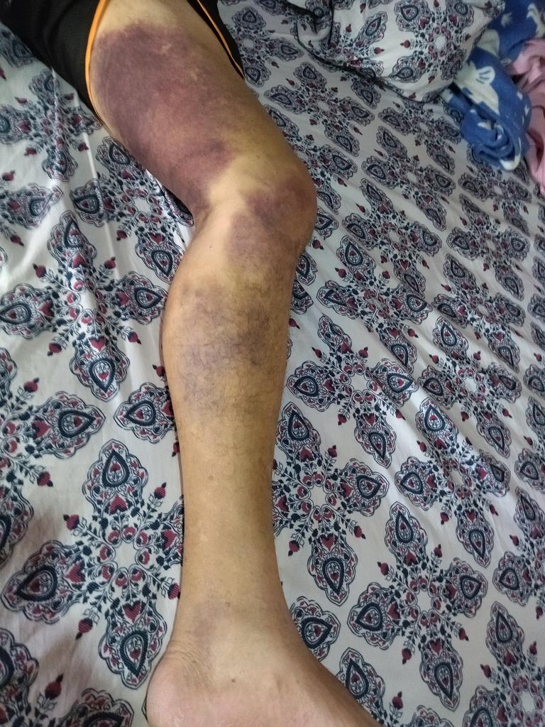 Mi papá con casi 70 años tiene que pasar 3 días haciendo cola para echar gasolina, dormir en el carro soportar calor, stress, rabia pq todo el mundo se aprovecha de q son viejos y se colean, una subida de tensión majestuosa y he aquí la consecuencia... Reclamos a quien?