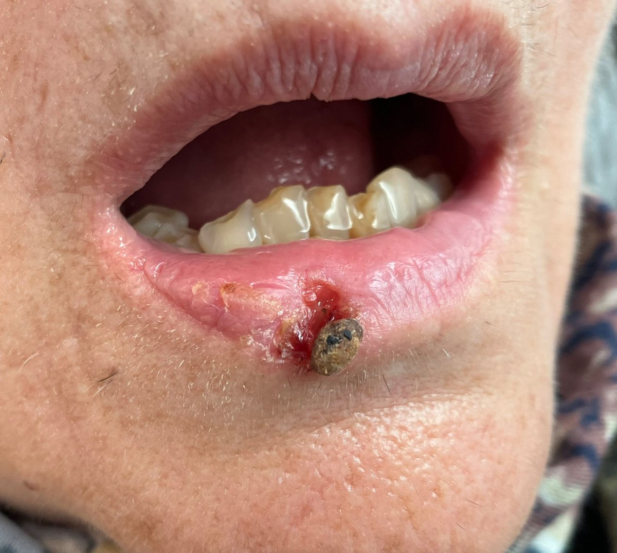 Derma_Photo's tweet image. CARCINOMA BASOCELULAR 1/2
Neoplasia cutánea más prevalente. Caracterizado por nidos de células basales atípicas, con escaso estroma desmoplásico. Factores predisponentes: Exposición solar, predisposición genética, y alteraciones en vía de señalización Hedgehog.

Fuente: @allobe86