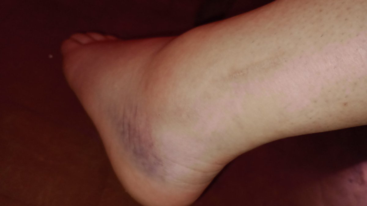 cuando me empezaba a sentir mejor día a día, sentía que cada vez jugaba mejorrr, y que cada día me superaba cada vez máss me tiene que pasar esto 
Pero las vida es haci y las cosas pasan por algo,  ahora toca recuperarse y volver más fuerte y mejor que nunca ❤️‍🩹⚽