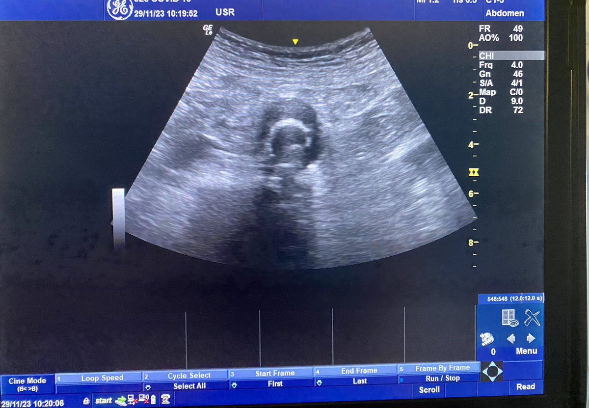 Qazi Zia Ullah (@drqazizia) on Twitter photo Enthusiastically coached POCUS for CT1 US day at St James's University Hospital, Leeds, with the insightful gurus this morning! ๐
๐จโโ๏ธ #POCUS #MedicalEducation #StJamesHospitalLeeds
<a href="/draroramohit/">#HelloMyNameIsMohit ๐ฌ๐ง๐ฎ๐ณ</a> <a href="/AdrisRazaq/">Adris Razaq</a> Enthusiastically coached POCUS for CT1 US day at St James's University Hospital, Leeds, with the insightful gurus this morning! ๐
๐จโโ๏ธ #POCUS #MedicalEducation #StJamesHospitalLeeds
<a href="/draroramohit/">#HelloMyNameIsMohit ๐ฌ๐ง๐ฎ๐ณ</a> <a href="/AdrisRazaq/">Adris Razaq</a>