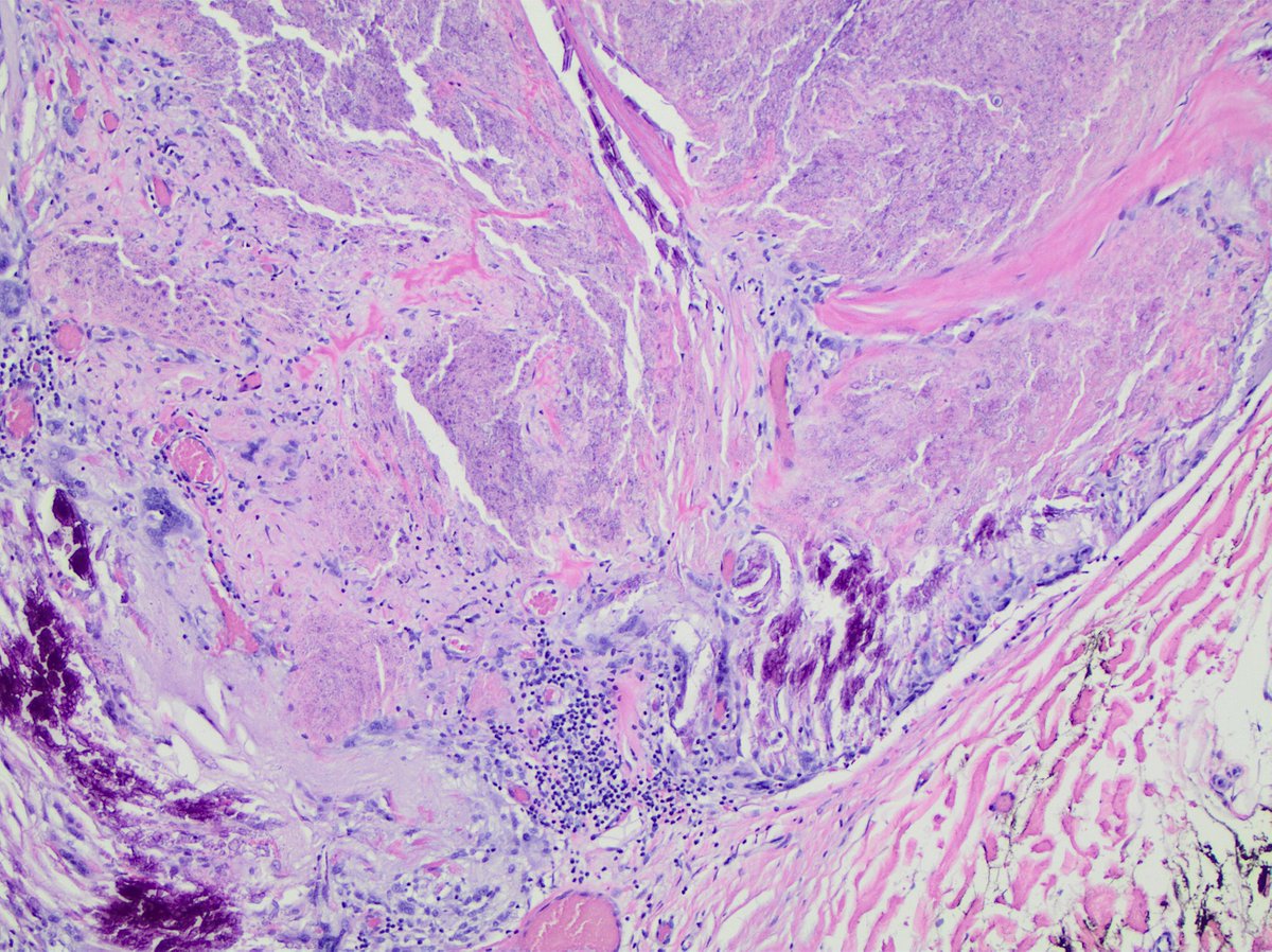 🏆 Pilomatrixoma

Pre-auricular hypoechoic subcutis mass, young woman

FNA Cyto: Anucleated squames, shadow cells, MN giant cells &amp; basaloid cells (only rare cluster seen in this case, not shown in the images)
H&amp;E (right lower)

#CytoHistoCorrelation
#Cytology #SmallButSmart