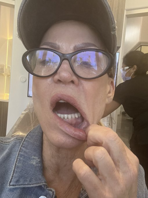 My dental emergency update I have a serious infection that has to be cleared up before the root canals<a href="/tag/liveonstreamate"class="tags"><span>#liveonstreamate</span></a><a href="/tag/pornqueen"class="tags"><span>#pornqueen</span></a><a href="/tag/amberlynn"class="tags"><span>#amberlynn</span></a><a href="/tag/streamatemodels"class="tags"><span>#streamatemodels</span></a>