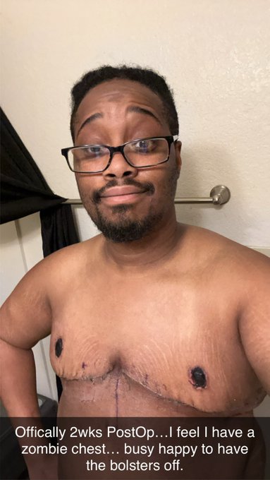 Still a lot  healing to go but couldn&rsquo;t be happier.  #topsurgery https://t.co/qGS0aQDo80<a href="/tag/topsurgery"class="tags"><span>#topsurgery</span></a>