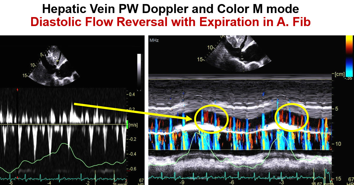 Since there is a high interest in color M mode of hepatic vein diastolic reversal flow (red flow) with expiration in constrictive pericarditis, I like to share another one with corresponding PW Doppler in a pt with constriction and atrial fibrillation. @ecocardio_cl @AJamilTajik