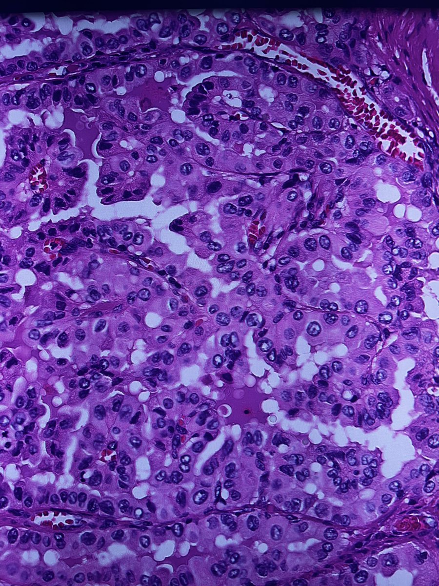 Tall cell or no? #PathTwitter #surgpath #payhology #pathologyfamily