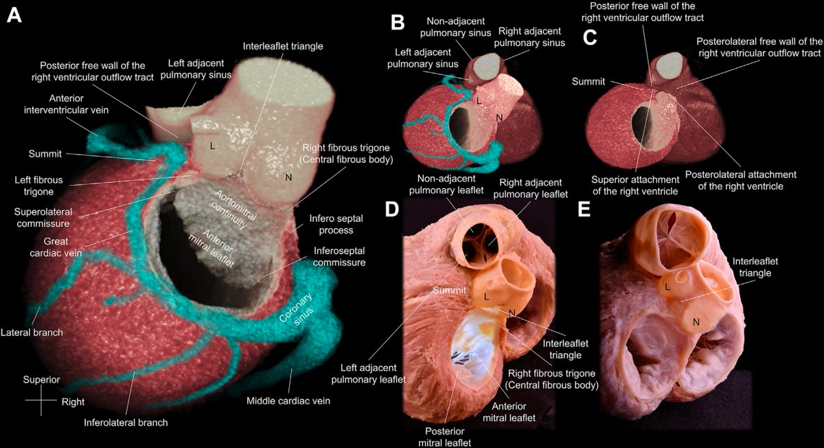 Posterior View of the Left Ventricular Summit