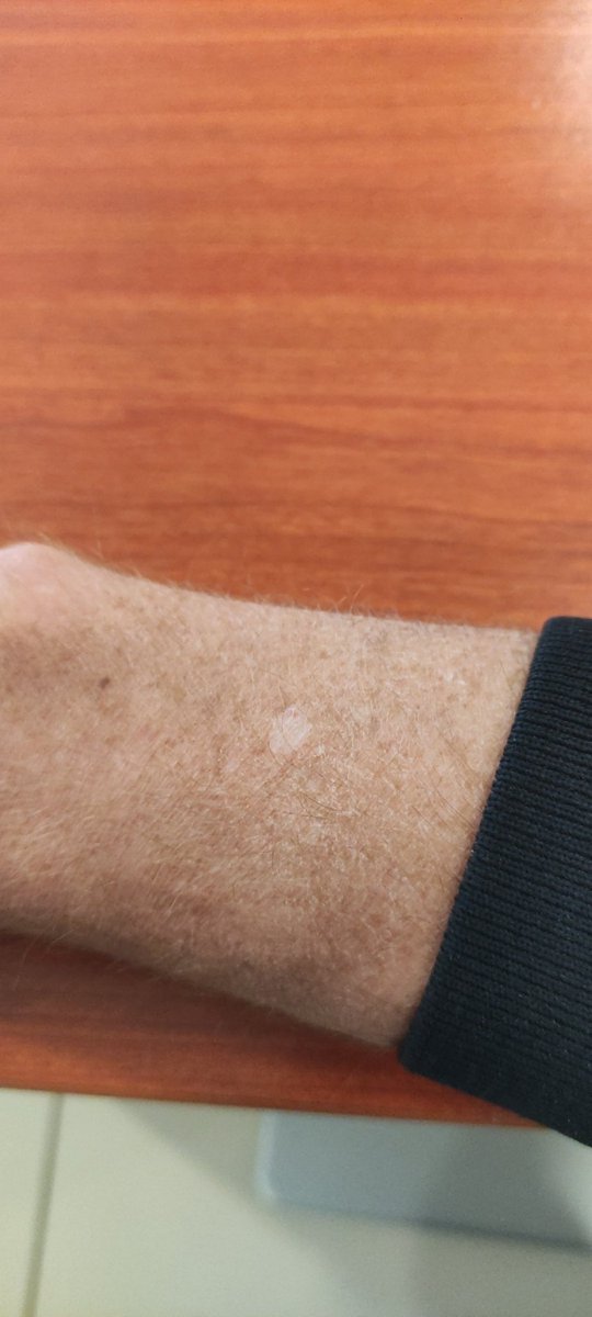 Badromeo34's tweet photo. @SamsungMobile Samsung watch 4 saatimin sensörünün derimi nasıl yaktığını görün.. sizi mahkemeye vereceğim. https://t.co/M6gt1ki2D4