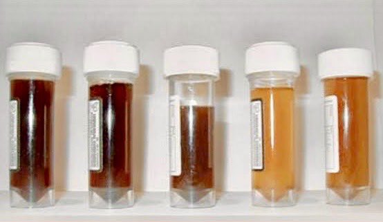 iamnephrologist's tweet photo. 💥Do you know⁉️

🔥Why Urine is brown in hematuria of upper urinary tract (Cola colored)?

🔆Prolonged contact of acidic urine with blood
👉Oxidation of heme pigment to Metheme derivative (Brown)

#NephroNotes #Nephpearls #FOAMed #MedTwitter #MedEd https://t.co/HhYqCO4aBV