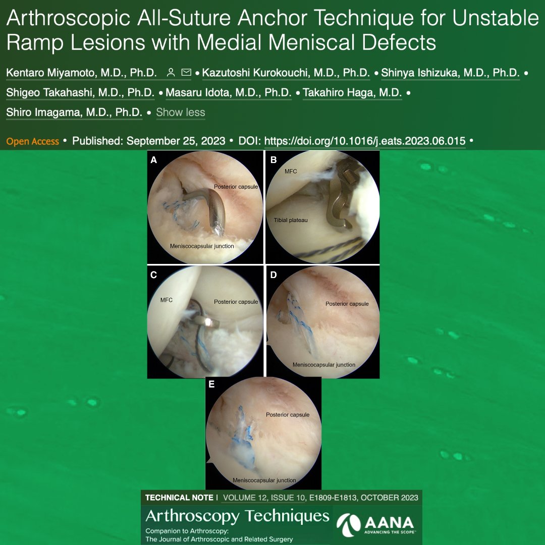 Check out this new arthroscopic repair technique using an all-suture anchor through a posteromedial portal for unstable ramp lesions with medial meniscal defects. ow.ly/ZMhw50Q4mPA #Sports #Meniscus #Ramp