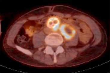 Throwback Thursday: Case Presentation: Mycotic Aortic Aneurysm and Psoas Abscess as a Complication of Bacillus Calmette-Guérin Instillations buff.ly/3Gh0igr #medtwitter #throwbackthursday