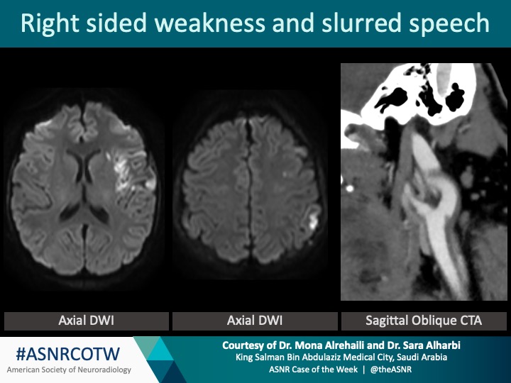 TheASNR's tweet photo. ASNR COTW #174

Hx: Right sided weakness and slurred speech

NO SPOILERS!!! Give hints in the form of GIF or answer attached poll.  Answer in 24 hrs        

#Neuro #Neurorad #Erad #radres #FOAMed #FOAMrad #medtwitter #ASNRCOTW https://t.co/sck9QNV9nP
