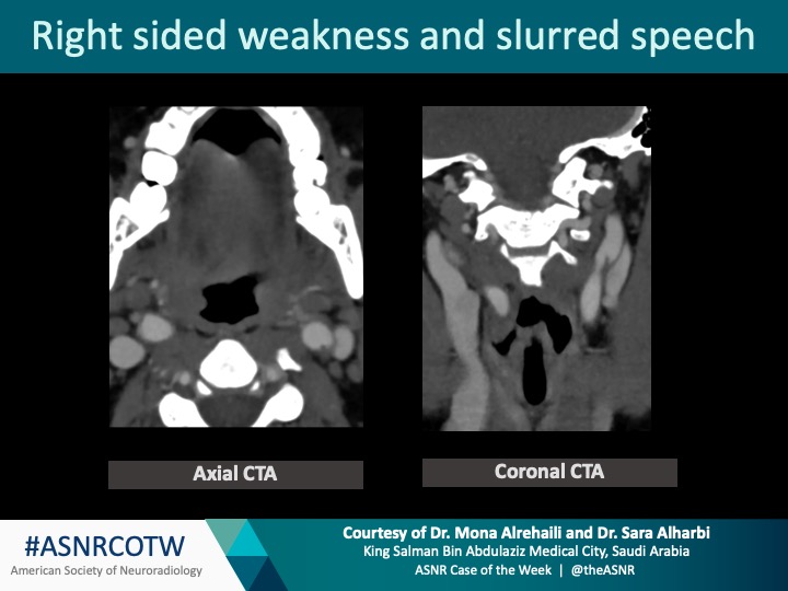 TheASNR's tweet photo. ASNR COTW #174

Hx: Right sided weakness and slurred speech

NO SPOILERS!!! Give hints in the form of GIF or answer attached poll.  Answer in 24 hrs        

#Neuro #Neurorad #Erad #radres #FOAMed #FOAMrad #medtwitter #ASNRCOTW https://t.co/sck9QNV9nP