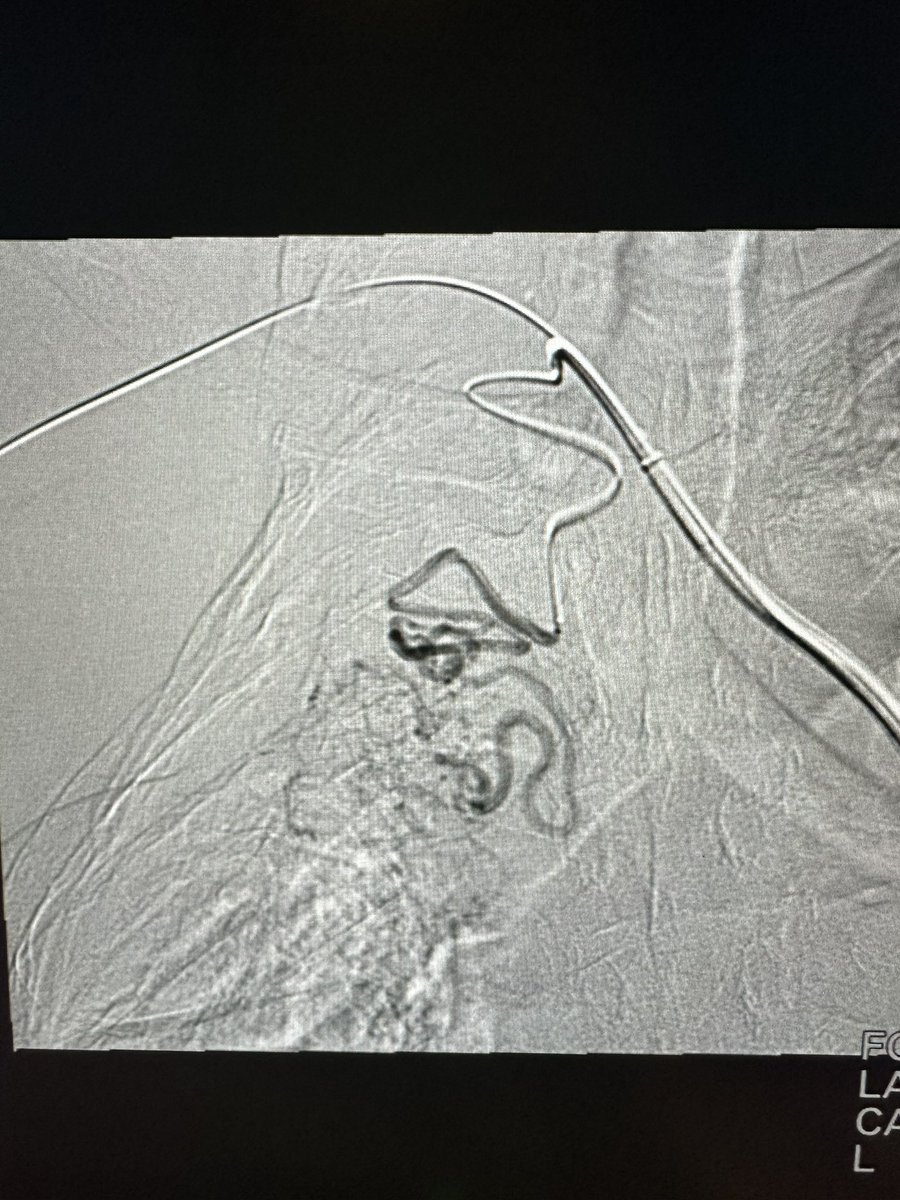 So we opted for a sheath with a stabilizing wire in the arm and a buddy reverse-curve catheter. 

Extremely useful technique for unstable catheter systems in general (vascular and non-vascular).