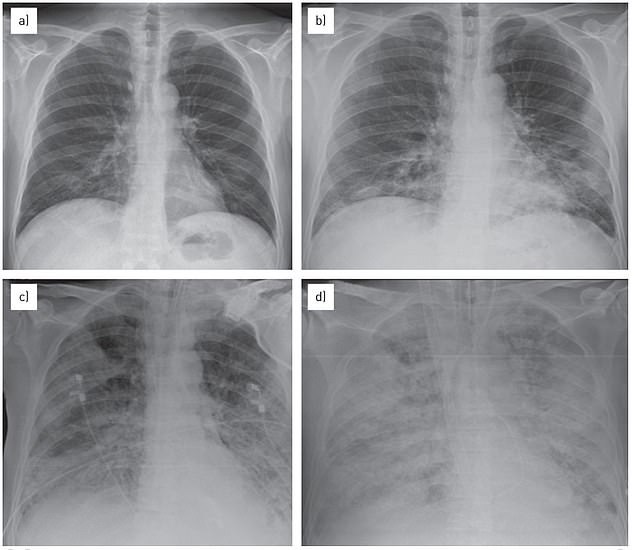 charliekirk11's tweet photo. JUST IN—The "Mystery pneumonia" affecting kids and ripping through China and parts of Europe, is reportedly now in America. 

142 child cases of "white lung syndrome" have now been recorded in Warren County, Ohio since August, meaning if true, it's been here for months.

CDC officials are saying "nothing is out of the ordinary" but according to county health official "Not only is this above the county average, it also meets the Ohio Department of Health definition of an outbreak."

Just in time for election season! 

Whatever is going on, never again and do not comply.