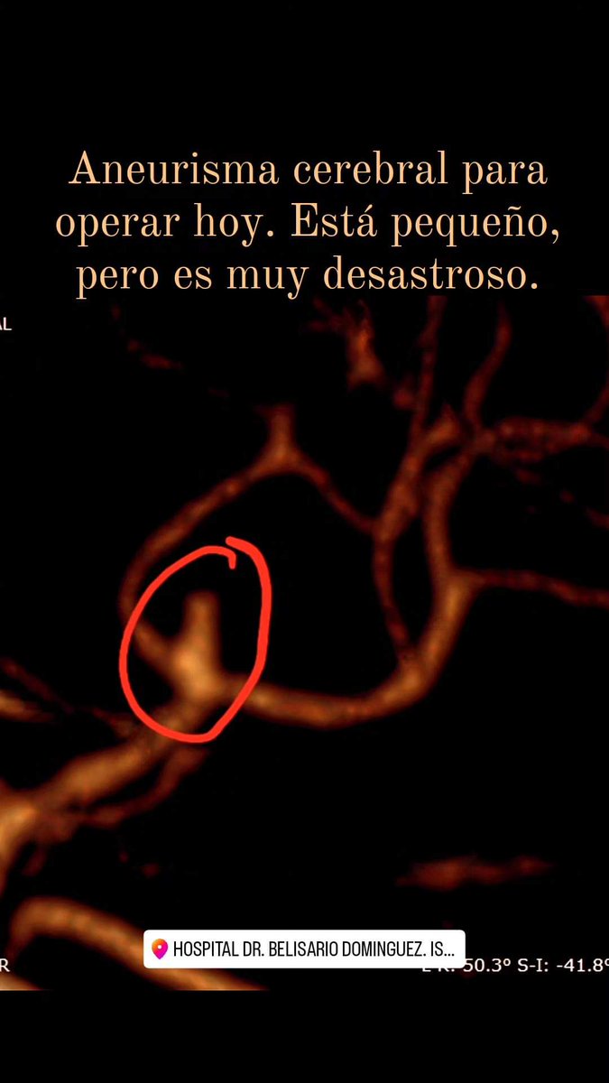 radamesrc's tweet photo. Aneurisma cerebral roto clipado, se muestra la AngioTAC de control. Se muestra también el estudio antes de la cirugía. Siempre a favor de un clipaje temprano, antes de los 3 días de la ruptura. https://t.co/r9fEEsjFk3