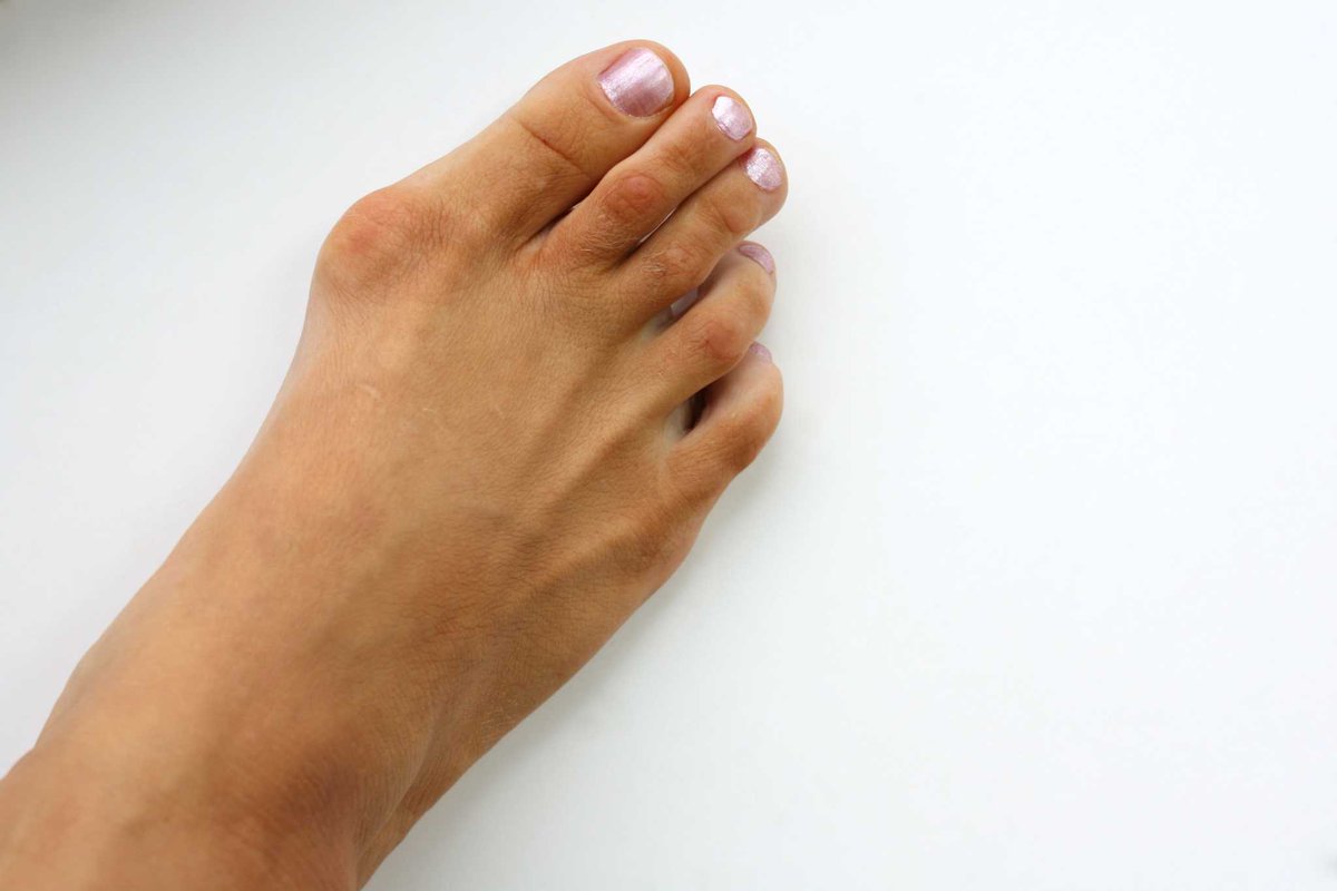 BurlingtonFoot's tweet photo. Bunions causing a bump in your day? Our experienced team offers personalized solutions to ensure you're on your way to bunion-free comfort. #FootCare #BunionSupport
https://t.co/qg8vVuBkOB https://t.co/9JWCsOnu5L