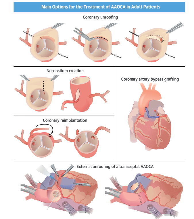 JMMComendador's tweet photo. 📌Revisión indispensable de @JACCJournals que trata el manejo en adultos de las anomalías coronarias de origen aórtico. 

🖊️No te pierdas los comentarios y resumen en el blog cirugía cardíaca hoy➡️https://t.co/JBiuVtdSO9 https://t.co/f9psto9PqU