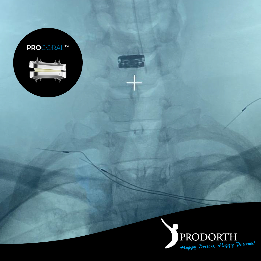 📌 Anterior Cervical Disc Prosthesis

🎯 Motion Preservation
🎯 PROCORAL™

📍 Mexico 🇲🇽

#prodorthspine #spinehealth #spinesurgery #spinedoctor #spinedevice #spineimplants #postoperative #spinalfusionwarrior #discprostehis #anteriorcervical #postoperative #motionpreservation