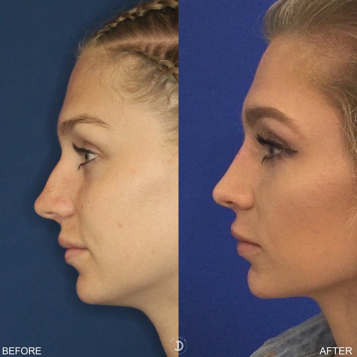 Invisible Rhinoplasty