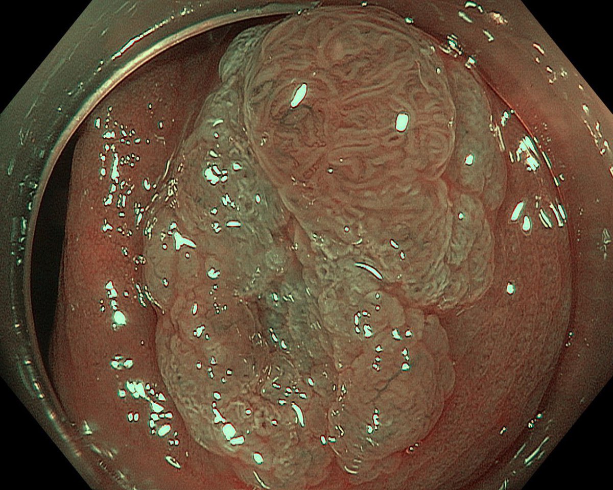 66 y.o male came in for a screening colonoscopy.
In the ascending colon Paris 0-II-a lesion up to 15mm was visualised.
Acetic acid chromoscopy was performed.
Share your thoughts on optical diagnosis in the comments.
#endoscopy
#CancerPrevention
