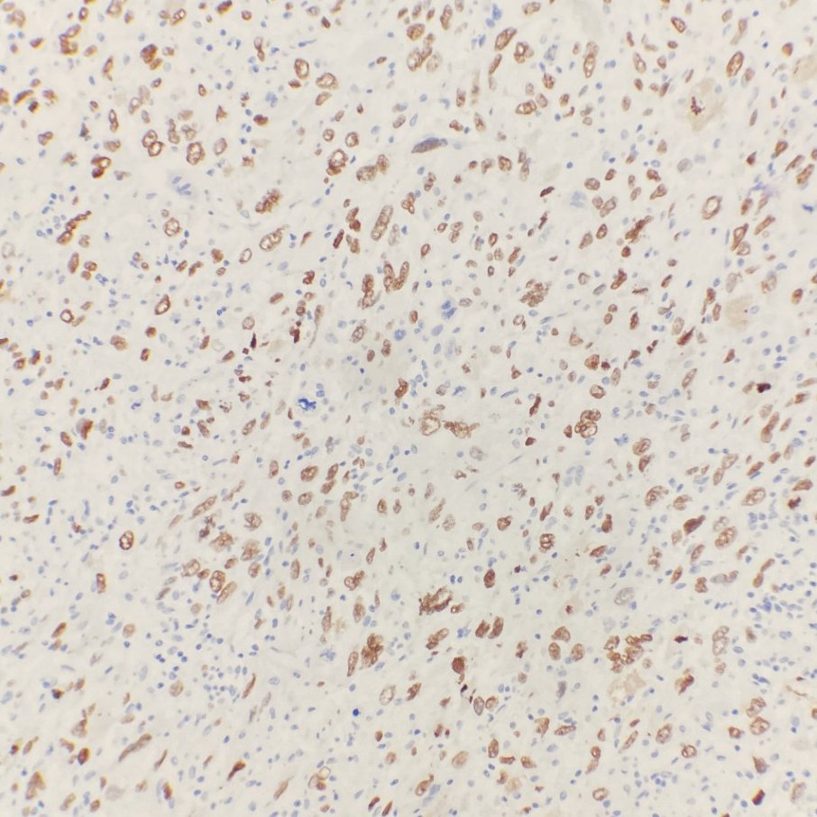 Osteosarcoma can be tricky. This one showed a fibroblastic morphology with only very focal osteoid. The SATB2 clinched the diagnosis! #BSTPath #PathTwitter #PathX