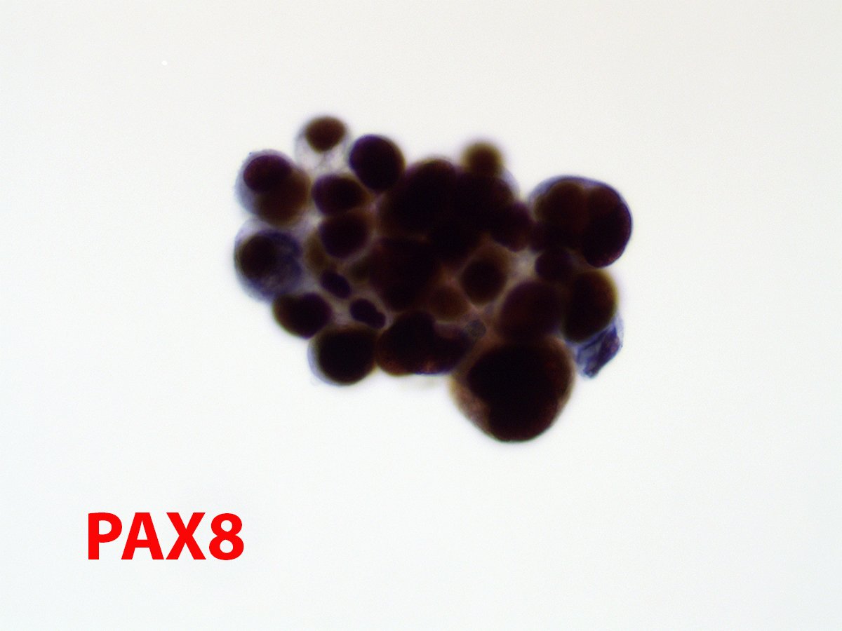 gcai1978's tweet image. Uterine serous carcinoma in pelvic wash specimen, highlighted by PAX8 immunostain (performed on an additional Thin-Prep slide). #PathTwitter #cytopath #cytology