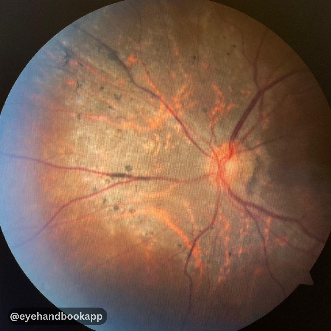 What's your diagnosis and list of differentials?
Check ALT (image description) for more info.

#eyes #clinicalcalculators #eyecalculators #ophthalmologist #optometrist #eyedoctors #ophthalmology #optometry #cornea #ophthalmologyresident #free #optometryresident #oftalmologia