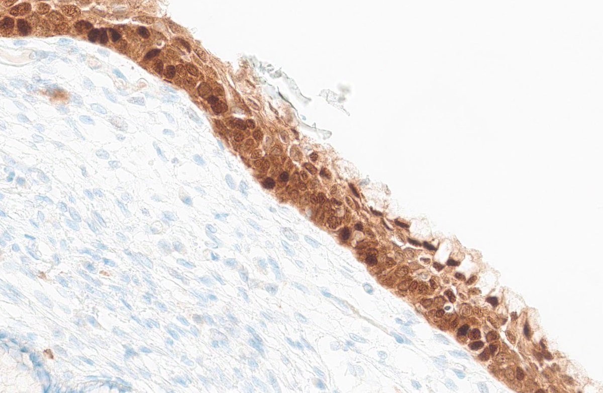 “Thin” HSIL
▶️Variant of HSIL <10 cells thick
▶️May be missed on low power
▶️High power shows characteristic nuclear changes of HSIL
▶️p16 block-like 
#gynpath