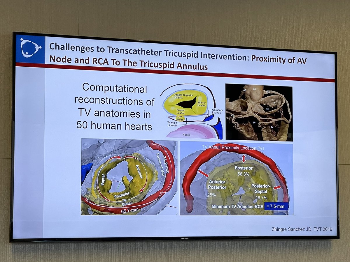 Comprehensive lecture this AM by the TV master himself @matthewjpricemd about TV interventions currently in clinical trials, review of the latest data for TTVR/clip. We are grateful to train at an institution so involved in the research on the TV frontier! nejm.org/doi/full/10.10…