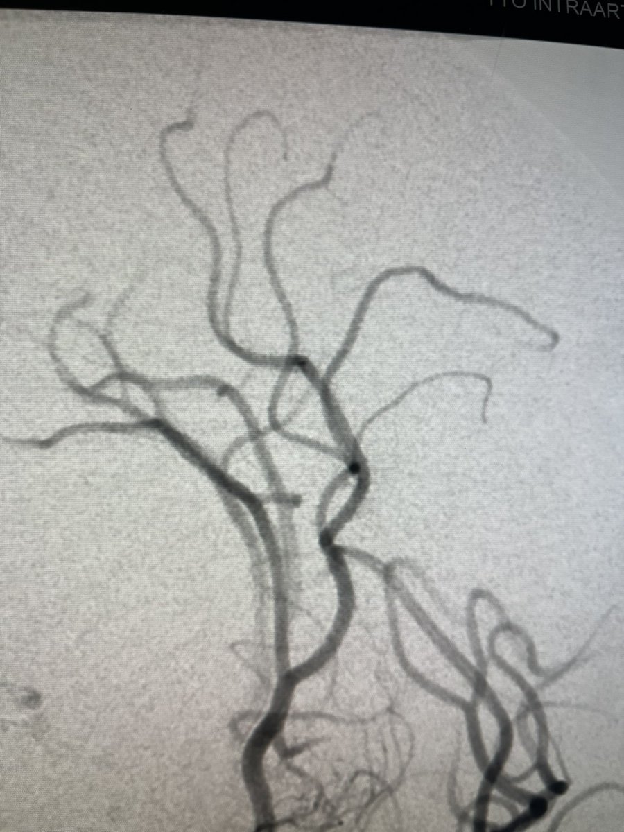 <a href="/Jc__Ray/">🇺🇦🇪🇸🇺🇳🇷🇺Jc Rayon🤺🏨 aka CiudadanoTuerto</a> <a href="/somedocs/">Doctors On Social Media</a> <a href="/TheDA_UK/">Doctors’ Association UK</a> <a href="/The_ASSR/">American Society of Spine Radiology (ASSR)</a> <a href="/CanadianNeuroIR/">Canadian Interventional Neuro Group</a> <a href="/SERVEISoc/">SERVEI - Radiología Vascular Intervencionista</a> <a href="/VirTauli/">Radiologia Vascular Intervencionista Parc Taulí</a> <a href="/PazDanpaz2005/">Dan paz</a> <a href="/DanMeila/">Dan Meila</a> <a href="/UKStrokeForum/">UK Stroke Forum</a> <a href="/frenoalictus/">Fundación Freno al ICTUS</a> <a href="/Ictus_Girona/">Unitat d'Ictus Girona</a> <a href="/ictusaragon/">Asoc Ictus Aragon</a> <a href="/ADACEA/">Daño Cerebral Adacea Alicante</a> <a href="/AfricanStroke/">African Stroke Organization(ASO)</a> <a href="/GroupENA/">ENA Group 👁️</a> <a href="/StrokeStigma/">syntyche stroke awareness foundation</a> <a href="/WorldStrokeOrg/">World Stroke Org</a> <a href="/StrokeAHA_ASA/">Stroke AHA/ASA</a> <a href="/StrokeBern/">Stroke Research Center Bern</a> @StratNeuro <a href="/TheCSNR/">The Canadian Society of Neuroradiology</a> <a href="/seneurologia/">SEN</a> <a href="/SENC_/">SENC</a> <a href="/residentesSERAM/">Residentes SERAM</a> <a href="/cardioHGUA/">Cardiologia HGU Dr.Balmis de Alicante</a> <a href="/UCI_HGUAlicante/">HGUCI-Alicante</a> <a href="/anestesialic/">Anestesia Alicante</a> <a href="/esmintsociety/">ESMINT Society</a> <a href="/ESOstroke/">European Stroke Org</a> <a href="/ESNRad/">ESNR</a> <a href="/svinsociety/">SVIN</a> <a href="/SNISinfo/">SNIS Info</a> <a href="/MThrombectomy/">Mission Thrombectomy</a> @TheKSNR <a href="/mena_sino/">MENA-SINO</a> <a href="/UKNGNeuro/">UKNG</a> <a href="/YoungNIR/">YoungNIR</a> <a href="/sfnr_jeni/">JENI SFNR</a> <a href="/realyoungcaans/">Young African Neurosurgeons Forum</a> <a href="/brainconferenc1/">BRAIN Conference</a> <a href="/YOUNICORN19/">@YOUNICORN</a> <a href="/WFNS_YNF/">WFNS Young Neurosurgeons Forum</a> <a href="/youngstroke_org/">YoungStroke</a> <a href="/elvijimenezgo/">Elvira Jimenez</a> <a href="/_AdnanSiddiqui/">Adnan H. Siddiqui, MD</a> <a href="/daigaole/">Dr. Dai</a>