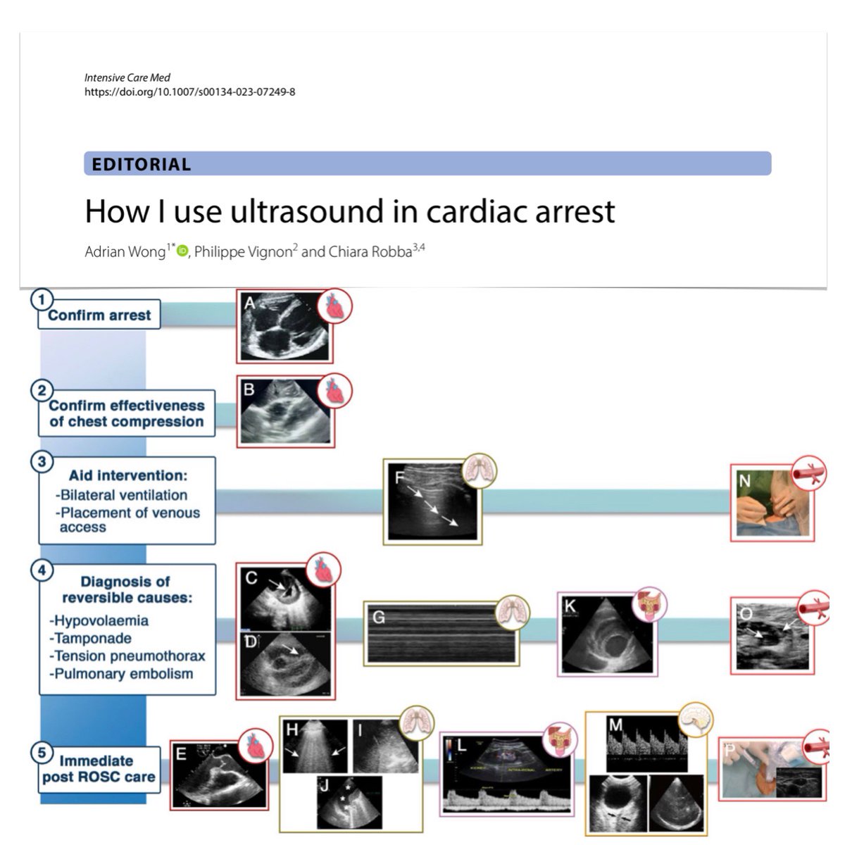 yourICM's tweet photo. How I use #ultrasound in cardiac arrest
🫀#POCUS to confirm CA &amp; guide management during cardiopulmonary resuscitation
🚨general assessment immediately after ROSC: hemodynamics &amp; circulatory support + non cardiac
🔮 future perspective
#FOAMcc #FOAMus
🔓https://t.co/eHThaBYHSA
🧵 https://t.co/ZrXfGh3VKM