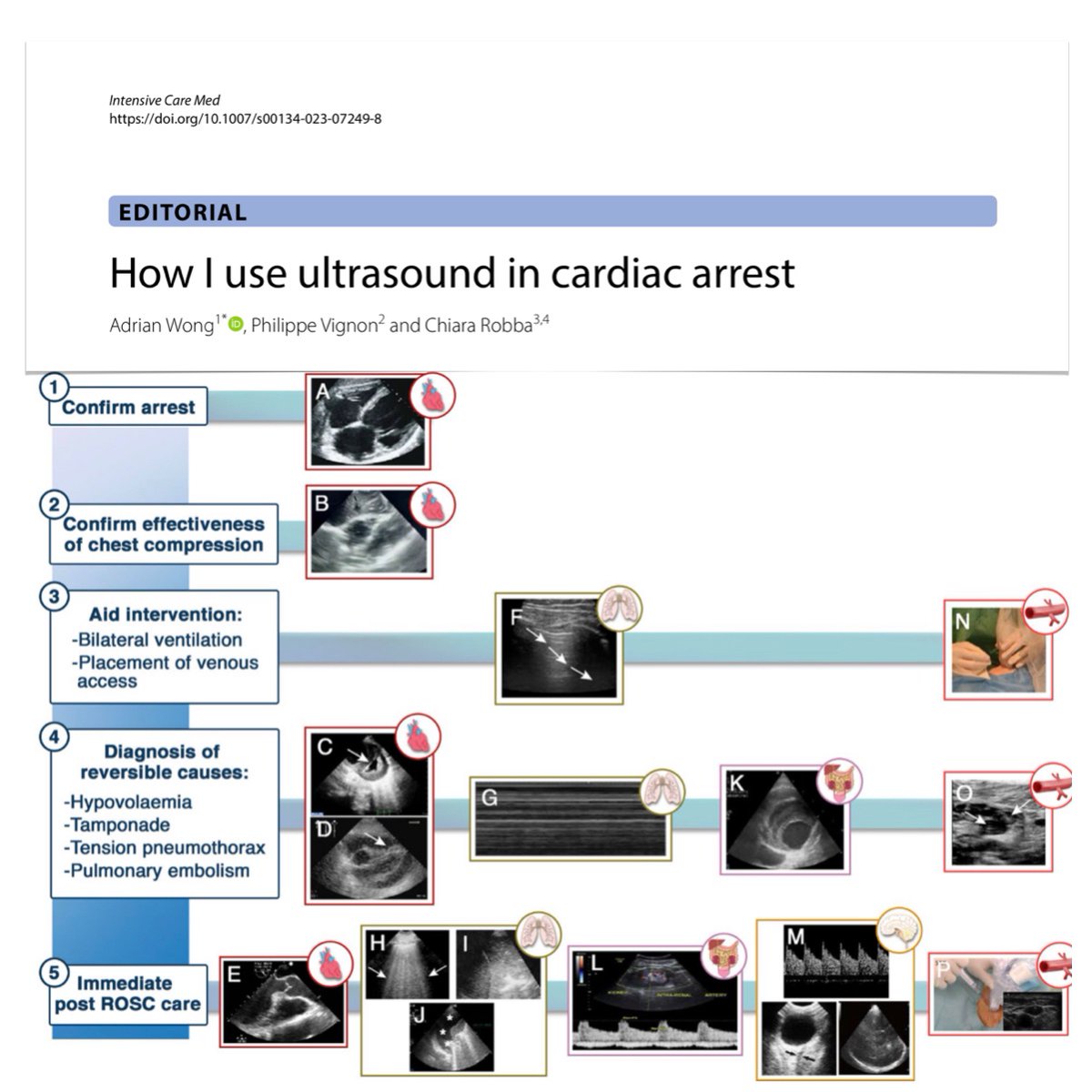 How I use #ultrasound in cardiac arrest 🫀#POCUS to confirm CA & guide management during cardiopulmonary resuscitation 🚨general assessment immediately after ROSC: hemodynamics & circulatory support + non cardiac 🔮 future perspective #FOAMcc #FOAMus 🔓rdcu.be/dsrQ8 🧵