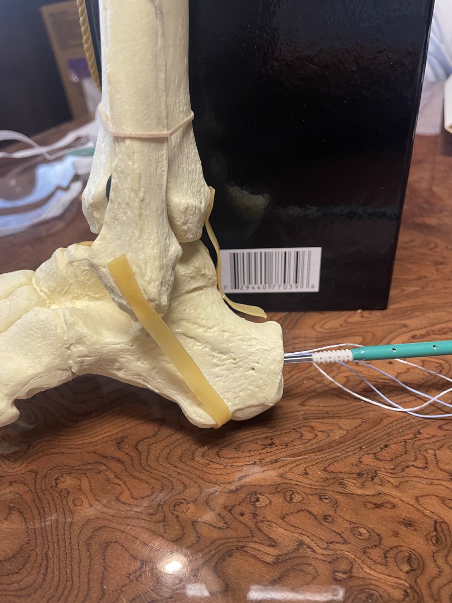 DrRobertKlapper's tweet image. #Achilles. New Technology allows us to fix these Tendon Tears in a BETTER way than Before. We REATTACH the Tendon to Bone. #SpeedBridge
