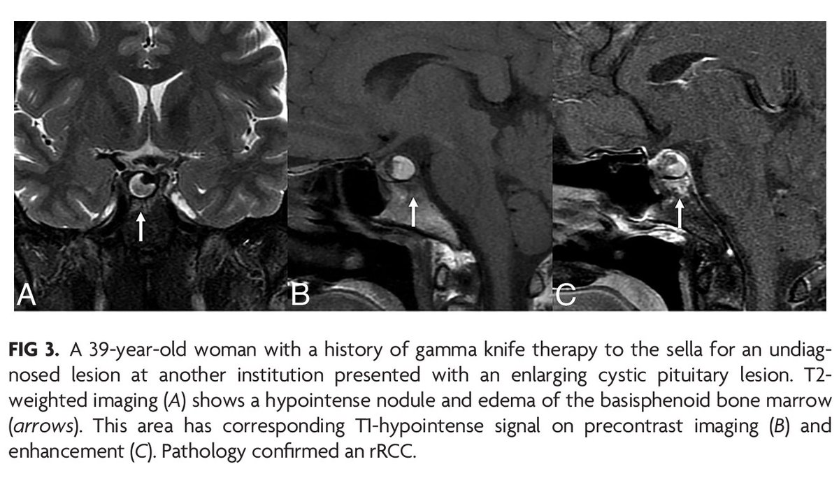 'MR Imaging Appearance of Ruptured Rathke Cleft Cyst and Associated Bone Marrow Enhancement' #RathkeCleftCyst #FellowsJournalClub #OpenAccess | ajnr.org/content/44/11/…