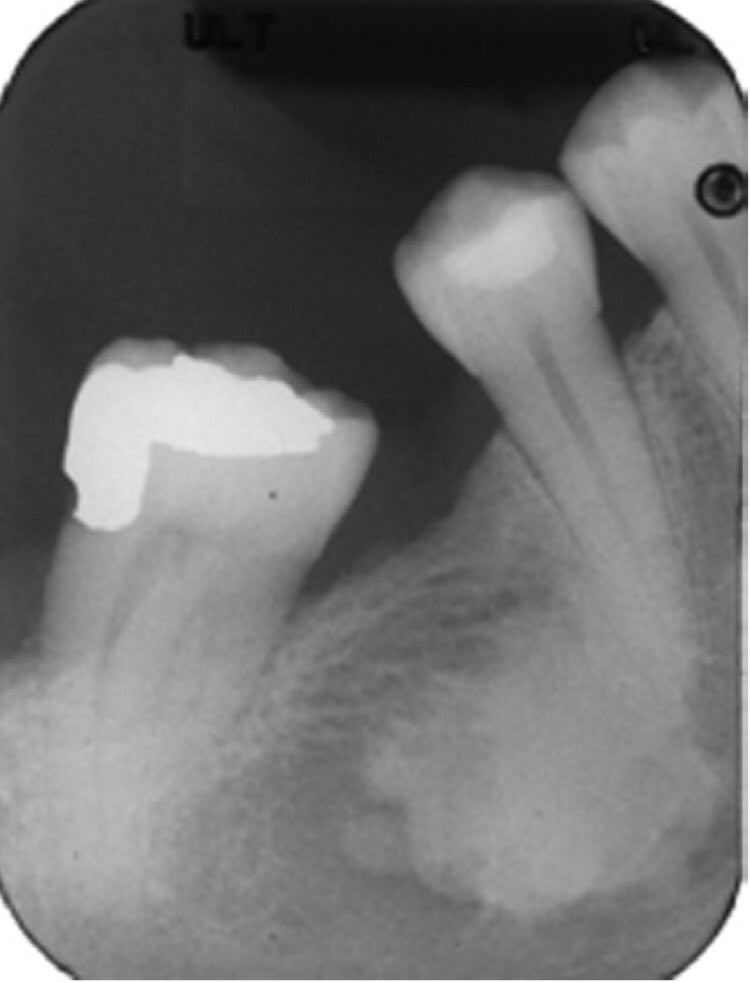 🔴 Dense bone island 🔴 🔷 The dense bone island is an asymptomatic, non- inflammatory hamartoma of bone that may or may not have an association with the teeth. ♦️ Should there be an association, the tooth pulp is vital. 🔷 Dense bone islands are well-defined, noncorticated,…