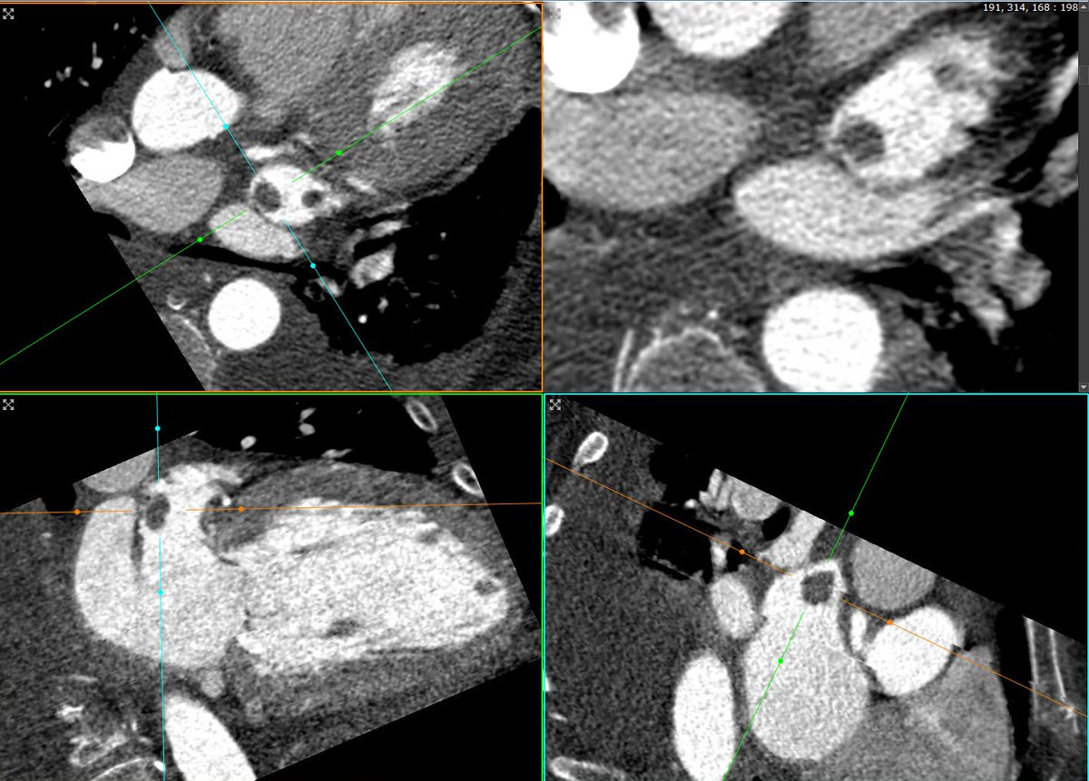 Always look carefully at the LAA on #YesCCT studies, specially among those for pre-TAVR/TMVR/TTVR evaluation! #ACCimaging @ACCinTouch @Heart_SCCT