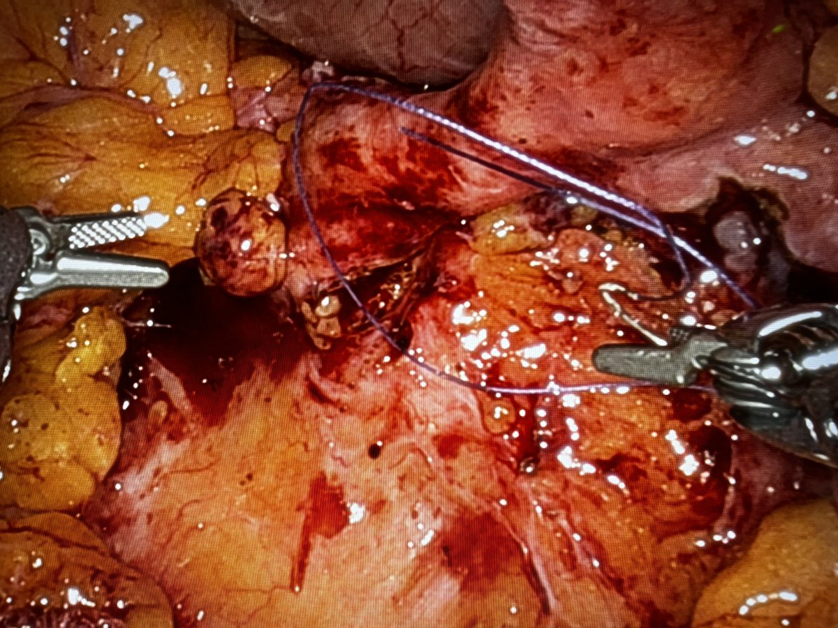 PavlakisPavlos's tweet photo. Robotic Revision of left Uretero ileal anastomosis  due to stricture in previous RARC + ileal conduit diversion https://t.co/KbYnAJl9hX