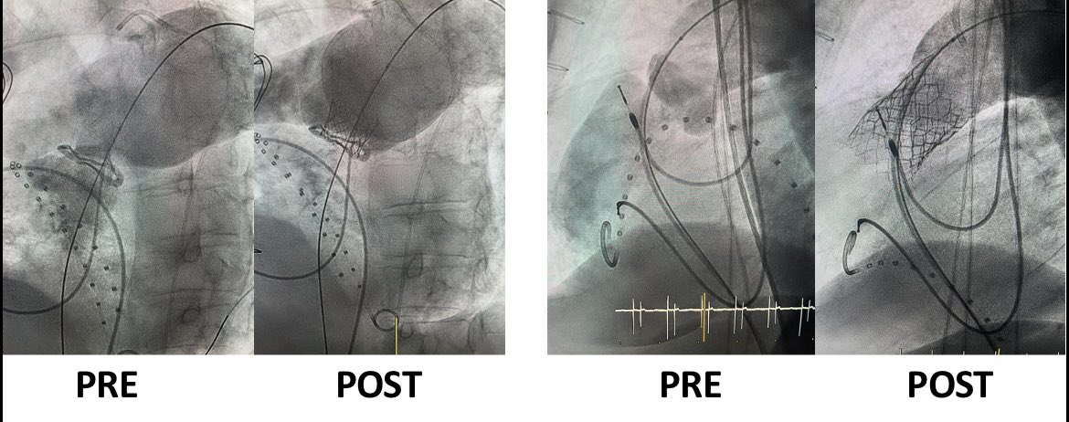 MPAOSS's tweet photo. Complex pulmonary valve implantation with Macarena team. S3 in degenerated Mitroflow &amp; native pulmonary regurgitation. @OjedaOjeda18 @belcid7 @AJuradoRoman @oriolrodriguez5 @evandrofilhobr @PCRonline @TCTMD @shci_sec @RevEspCardiol @HUReinaSofia @LAzzaliniMD @hemodin90 @MesaLola https://t.co/6P2o1PNhcN