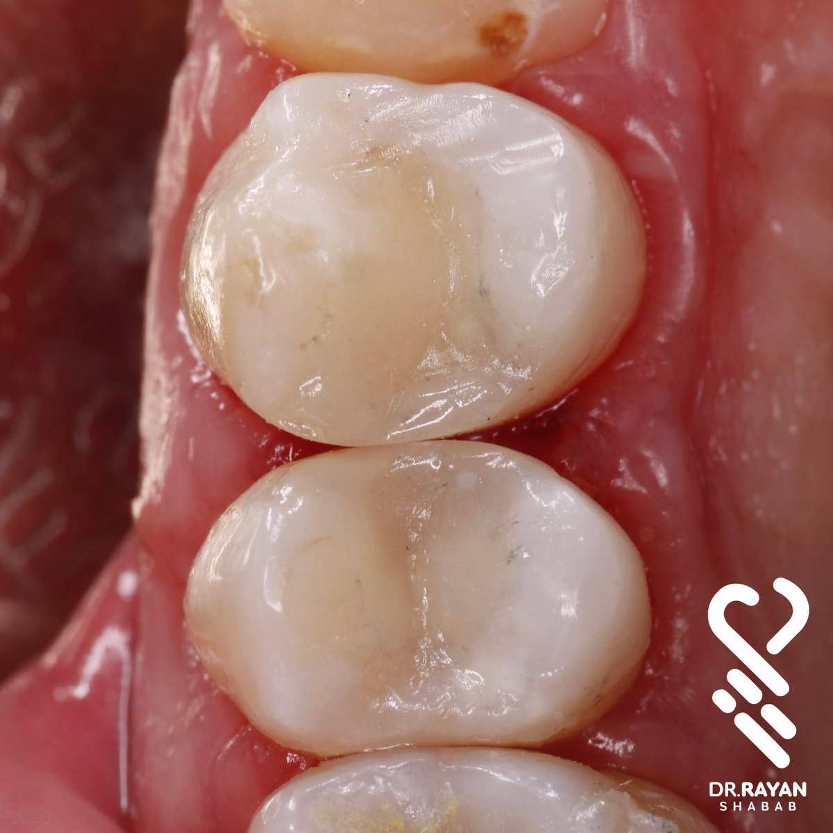 dr_ryn7's tweet photo. 📏📐🔐..Class II Premolar Face to Face

حاله لمراجعه تشتكي من هذه الأسنان وبعد الفحص تبين وجود تسوس بين الاسنان وتحت الحشوات وتم ازالتها وتعويضها بحشوات تحاكي شكل وتضاريس السن الطبيعي https://t.co/MBkOno0wkX
