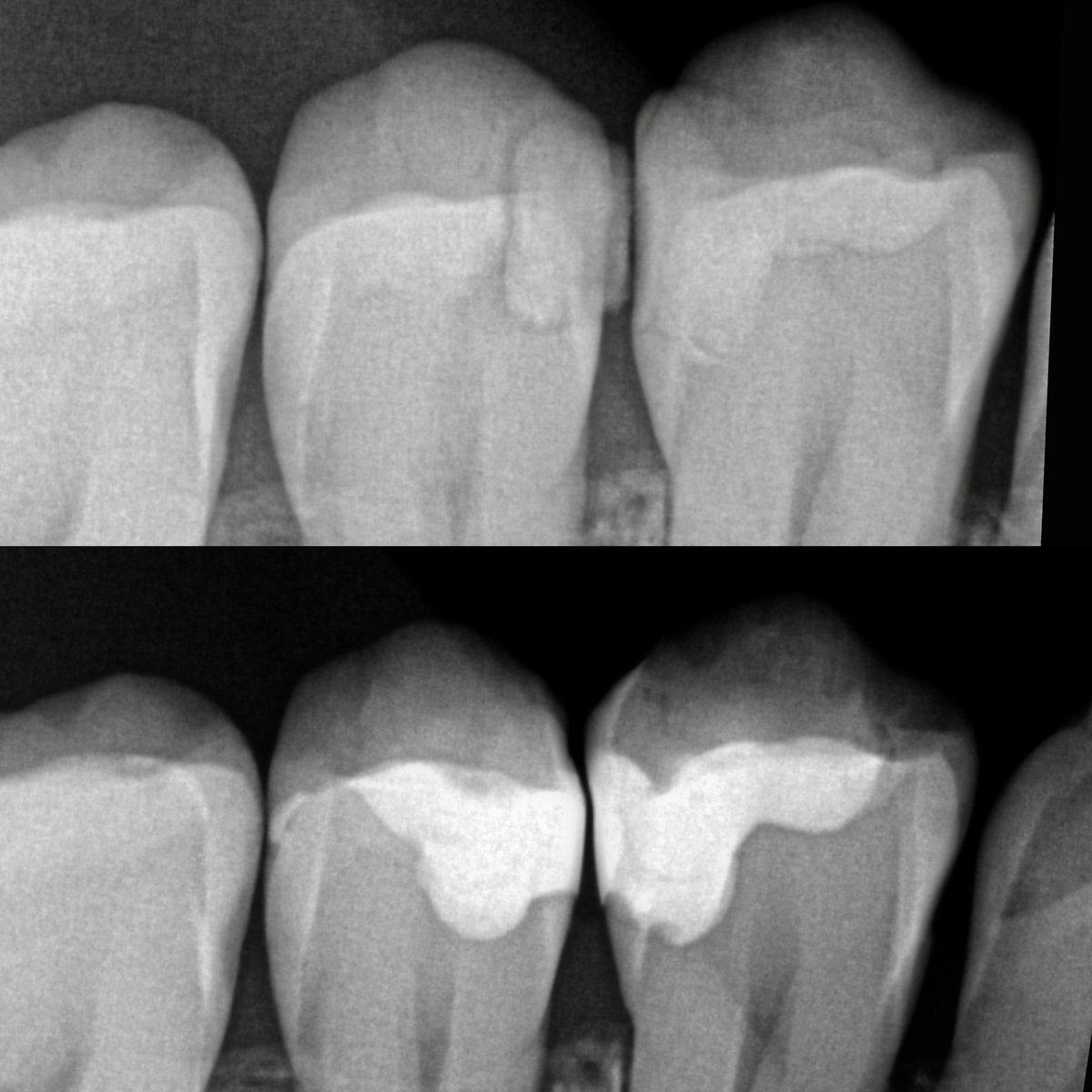 dr_ryn7's tweet photo. 📏📐🔐..Class II Premolar Face to Face

حاله لمراجعه تشتكي من هذه الأسنان وبعد الفحص تبين وجود تسوس بين الاسنان وتحت الحشوات وتم ازالتها وتعويضها بحشوات تحاكي شكل وتضاريس السن الطبيعي https://t.co/MBkOno0wkX