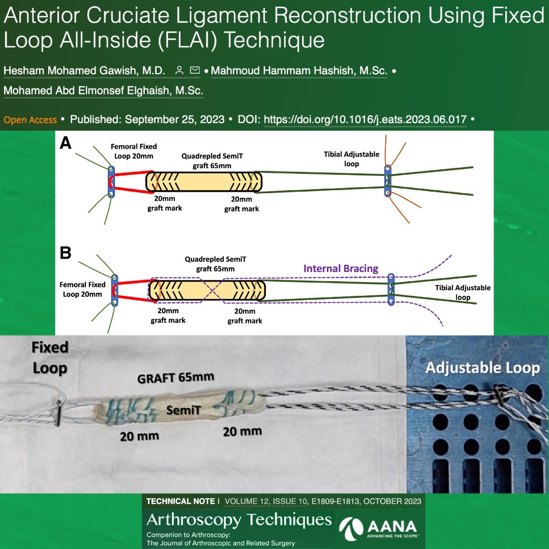 Want to prevent graft loosening during all inside ACL reconstruction? Check out this technique paper! ow.ly/reqf50Q4E4h. #ACL #Sports #Arthroscopy