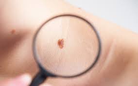 IPMontevideo's tweet photo. Científicos de @IPMontevideo y @hcmquintela desarrollan una técnica basada en el brillo de ciertas moléculas para simplificar la detección de #melanomas, el tipo de cáncer de piel con mayor tasa de mortalidad en el país y en el mundo. 
Te contamos más en este #hilo https://t.co/QmWy9ho95l