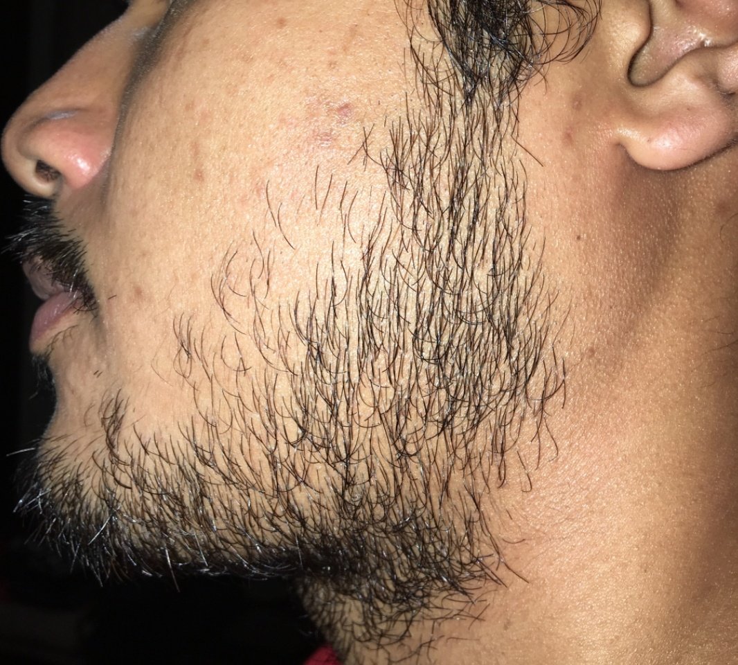 iamBawzCartel's tweet image. If your Beard is Patchy like this on the first frame, use Cheveux Organic Cream on the second frame.
I know how sad it feels to have a patchy beards.
I've been there before.
#BeardGuru