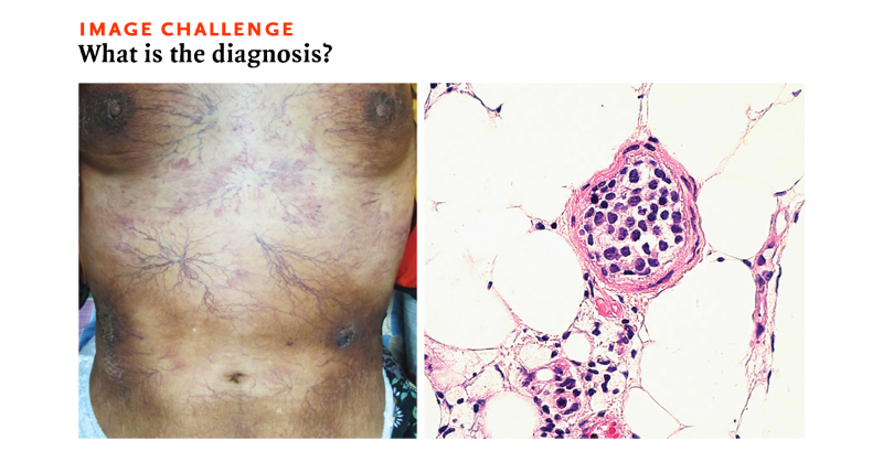 NEJM's tweet photo. A 53-year-old woman presented with a 3-month history of worsening vascular skin lesions and a 1-month history of fever. Read the full case details and submit your answer or see how others responded: https://t.co/WfrJpqpmc1